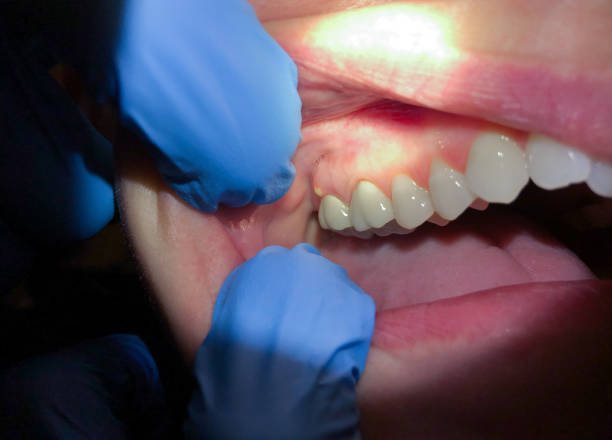 Best Emergency Tooth Extraction in Suffield Depot, CT