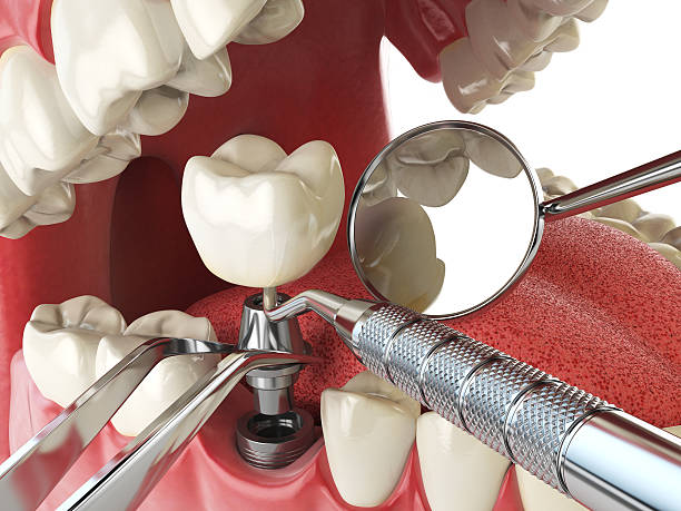 Best Urgent Care for Lost Fillings or Crowns in Suffield Depot, CT